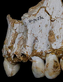 Tartre dentaire contenant des traces d'ADN de penicilline et d'aspirine chez Néandertal