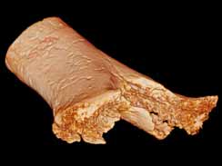 Amputation de l'humerus sur un squelette de Buthiers-Boulancourt