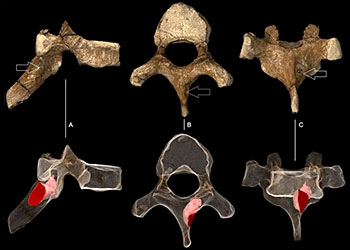 Vertèbres d'austropithecus sediba présentant des traces de lésion...