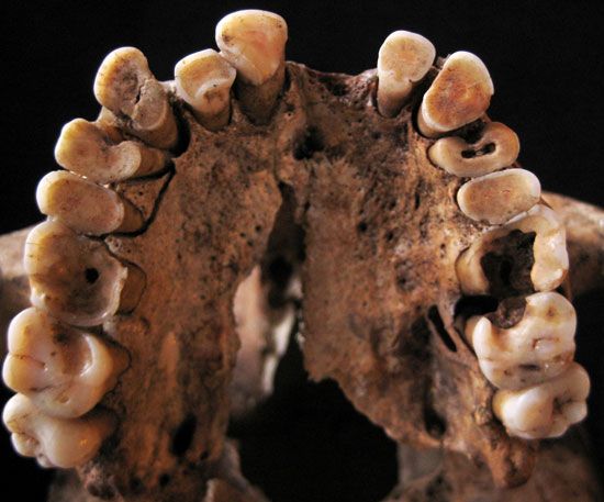 Des caries dentaires avant l'apparition de l'agriculture