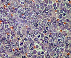 Histiocytose langerhansienne