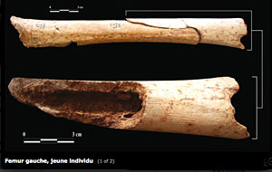 Fémur gauche fracturé retrouvé au Lazaret